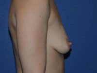 before breast augmentation right side view case 3415