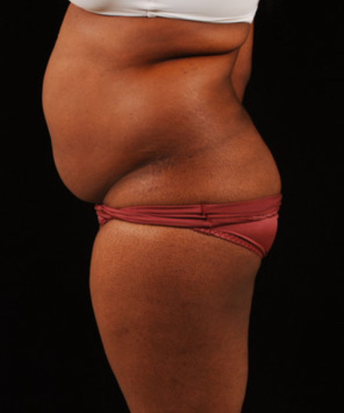 before liposuction side view female patient case 1473