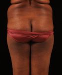 before liposuction back view female patient case 1473