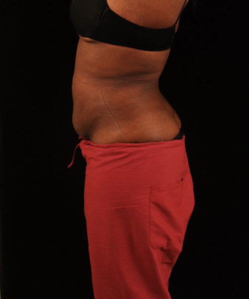 after liposuction side view female patient case 1473