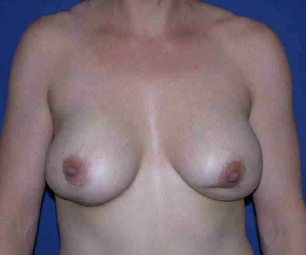 Before Breast Revision Surgery Female Patient Front Angle View Case 4569