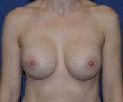 After Breast Revision Surgery Female Patient Front Angle View Case 4602