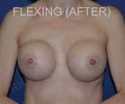 After Breast Revision Surgery Female Patient Front Angle flexed View Case 4602