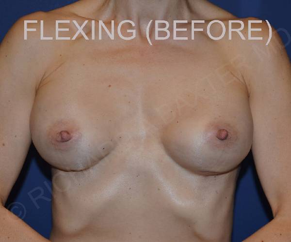 Before Breast Revision Surgery Female Patient Front Angle flexed View Case 4602