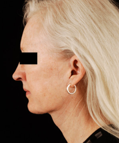 after chin implant female patient left side view case 4869