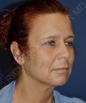 before facelift | neck lift female patient right angle view case 4831