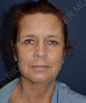 before facelift | neck lift female patient front view case 4831