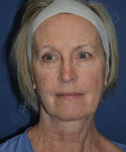 before facelift | neck lift female patient front view case 4839