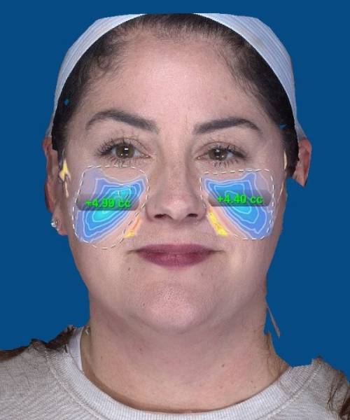 before facelift | neck lift female patient front view case 4849