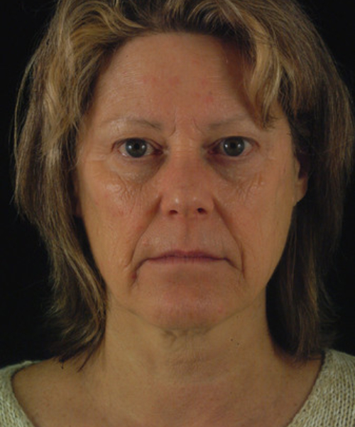 before facelift / neck lift front view female patient 5676