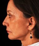 after facelift / neck lift side view female patient 5681