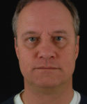 before facelift / neck lift front view male patient 5686