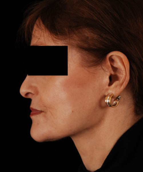 after facelift / neck lift side view female patient 5701