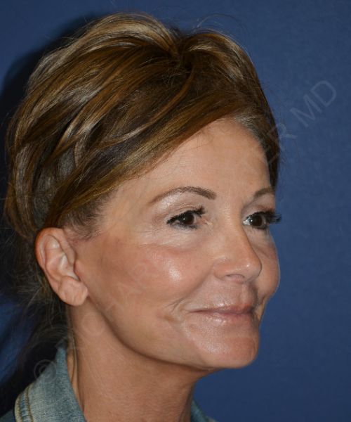 Facelift | Neck Lift Case 8887 - Phase Plastic Surgery | Dr. Baxter