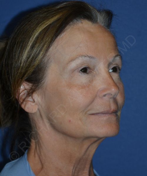 Facelift | Neck Lift Case 8887 - Phase Plastic Surgery | Dr. Baxter